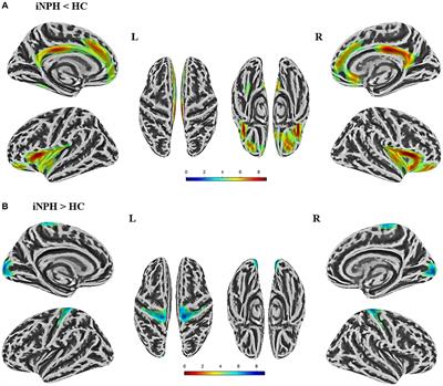 Improve the diagnosis of idiopathic normal pressure hydrocephalus by combining abnormal cortical thickness and ventricular morphometry